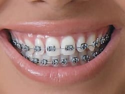 Governo vai oferecer aparelho ortodôntico e implante dentário
