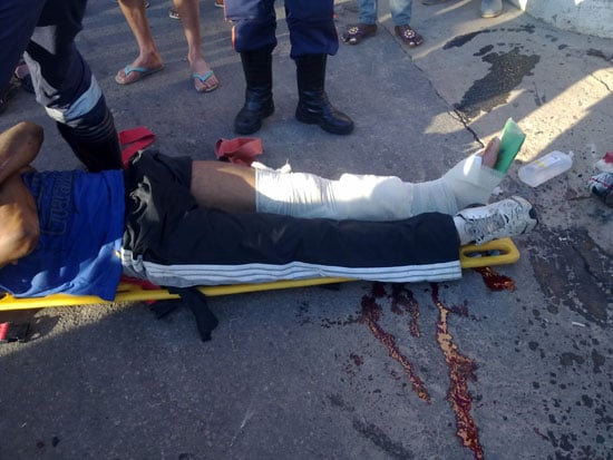 Inabilitado sofre fratura exposta ao bater de moto em caminhão