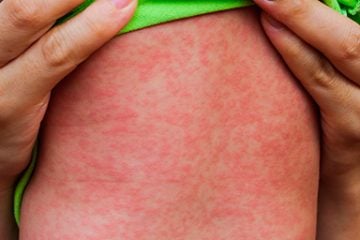 Com sintomas parecidos, dengue e sarampo não devem ser confundidos
