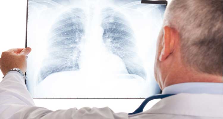 Pneumonia é a principal causa de morte em crianças menores de cinco anos em todo o mundo