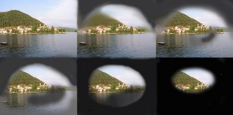 Glaucoma-o-que-e-quais-os-riscos-e-como-prevenir (1)