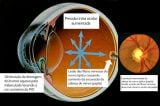 Glaucoma: o que é, quais os riscos e como prevenir?