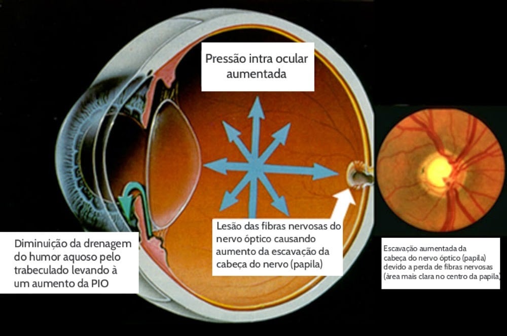 Glaucoma: o que é, quais os riscos e como prevenir?