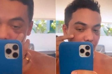 Wesley Safadão aparece com o olho roxo e assusta internautas