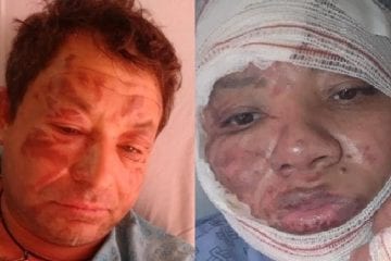 Cantor sertanejo sofre queimaduras graves em todo o corpo após explosão
