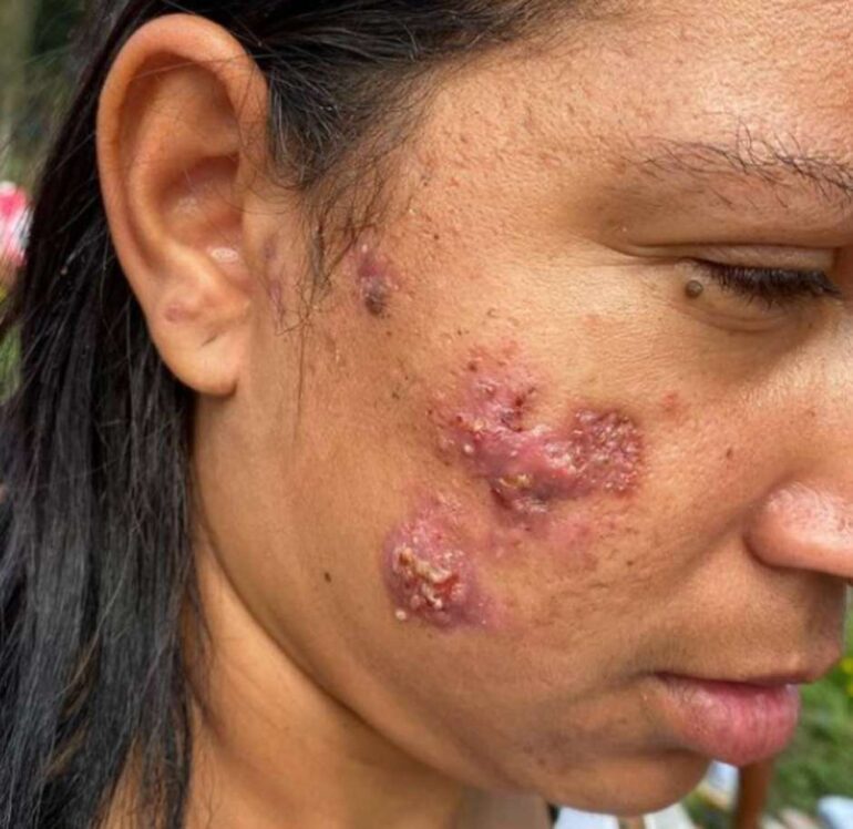 Surto de sarna humana atinge moradores do litoral de São Paulo