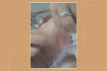 Paciente internada no hospital Santa Maria é encontrada com larvas na boca e no nariz