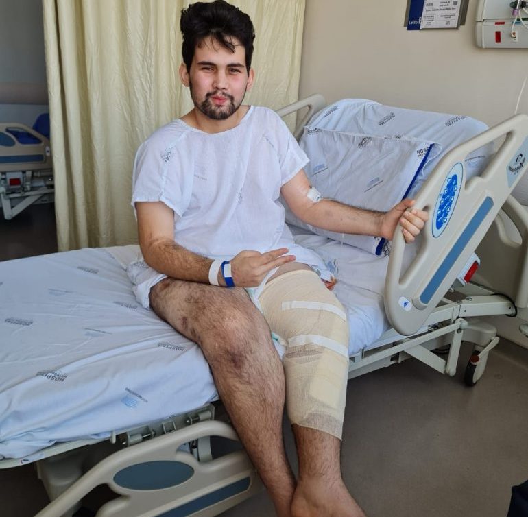 “Pensando na minha qualidade de vida, decidi amputar”, diz o itabirano Cadu