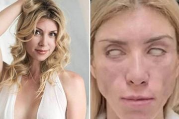 Miss russa fica sem sorrir e sem fechar os olhos após plásticas