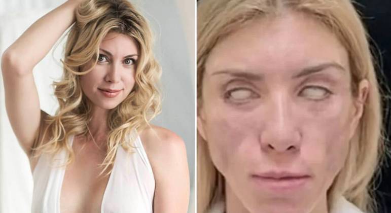 Miss russa fica sem sorrir e sem fechar os olhos após plásticas