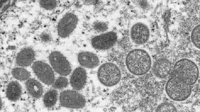 Varíola dos macacos: suspeita de primeira morte pela doença está sendo investigada em Minas