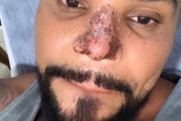 Naldo Benny tem princípio de necrose no nariz após procedimento estético