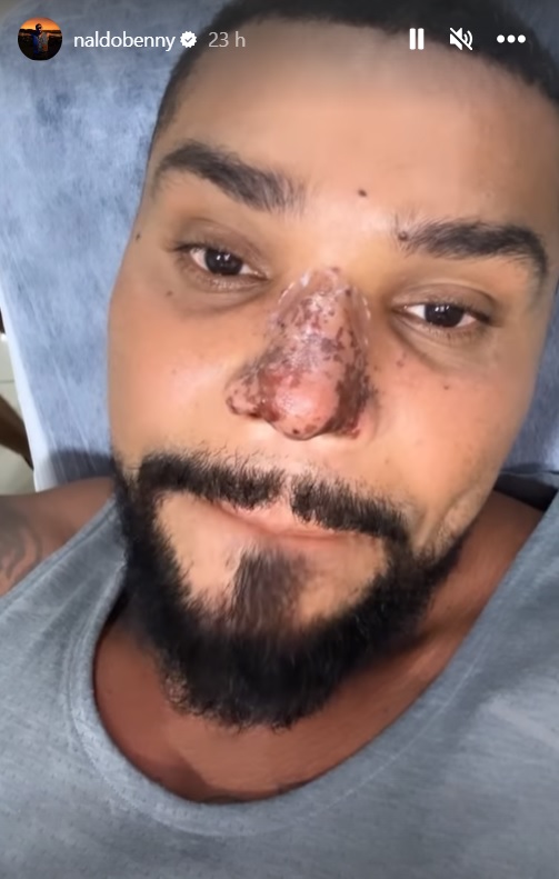 Naldo Benny tem princípio de necrose no nariz após procedimento estético