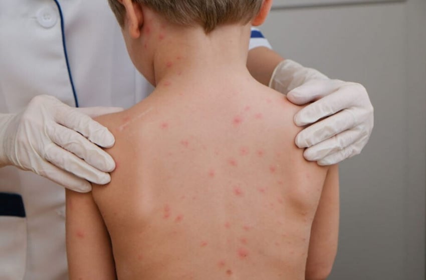 Prefeitura de Monlevade prossegue com vacinação contra meningite