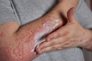 Projeto que prevê vacina de herpes-zoster no SUS está parado há um ano na Câmara dos Deputados