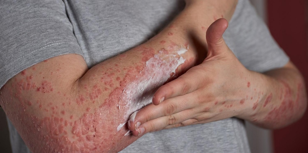 Projeto que prevê vacina de herpes-zoster no SUS está parado há um ano na Câmara dos Deputados