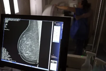 Cerca de 77 mil mulheres aguardam mamografia pelo SUS