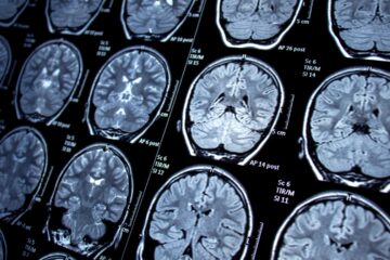 Itabira registrou 16 óbitos por AVC entre 2024 e 2025; falta de neurocirurgia impõe barreiras no tratamento de casos graves