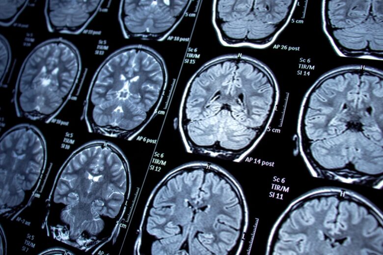 Itabira registrou 16 óbitos por AVC entre 2024 e 2025; falta de neurocirurgia impõe barreiras no tratamento de casos graves