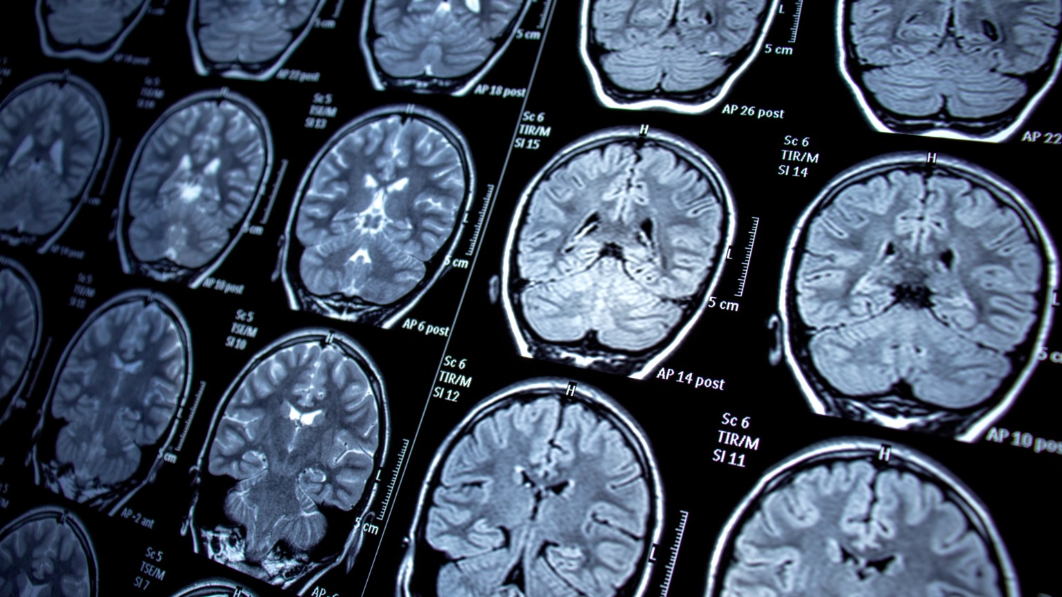 Itabira registrou 16 óbitos por AVC entre 2024 e 2025; falta de neurocirurgia impõe barreiras no tratamento de casos graves