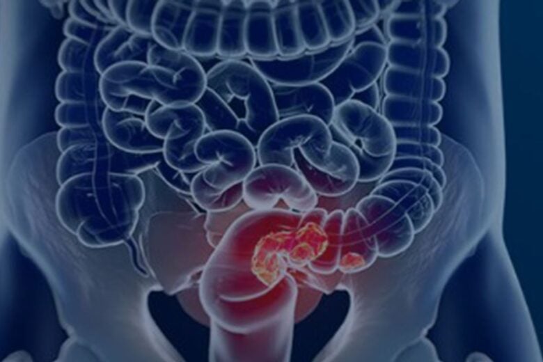 Câncer de intestino dá primeiros sinais no banheiro: veja hábitos de risco e como diagnosticar
