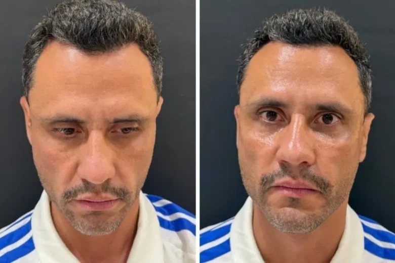 Cleitinho faz procedimento estético após ser eleito governador de MG