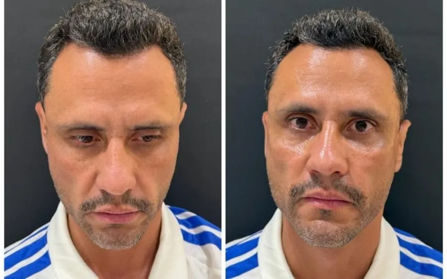 Cleitinho faz procedimento estético após ser eleito governador de MG